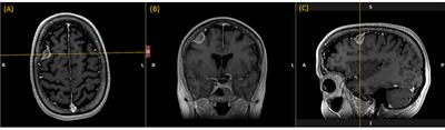 Measuring Efficiency of Semi-automated Brain Tumor Segmentation by Simulating User Interaction